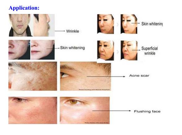 Micro needle RF face lifting machine