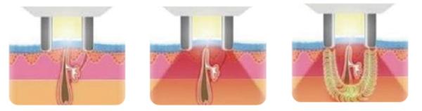 Portable Shr Ipl Machine Portable Shr Ipl Machine