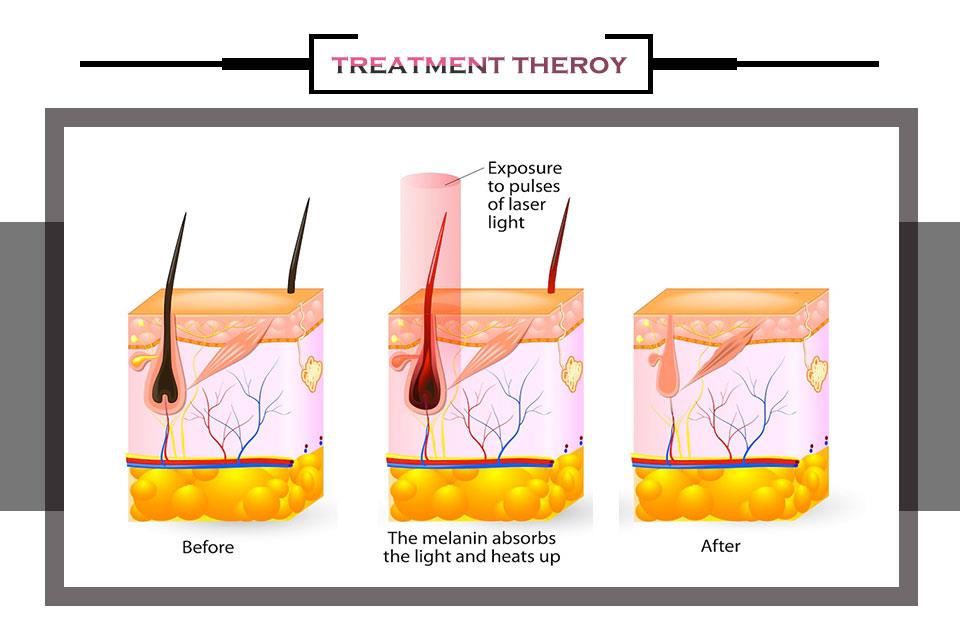 810nm Laser Hair Removal Machine
