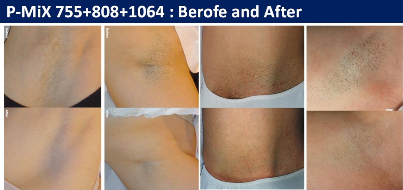 Triple Wavelength Diode Laser Hair Removal