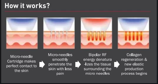   Sanhe Newest Fractional RF Micro Needling ( FRM )